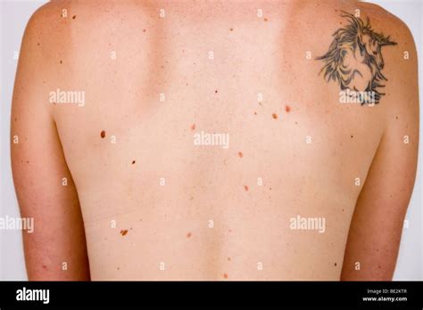 Moles On The Back Skin Cancer Risk Stock Photo Alamy