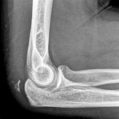 9 Complete Rupture Of The Triceps Tendon On Magnetic Resonance Imaging