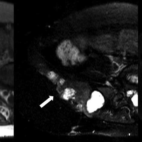Pelvic Mri Pre Contrast T1 Fat Saturated T2 And Postcontrast T1