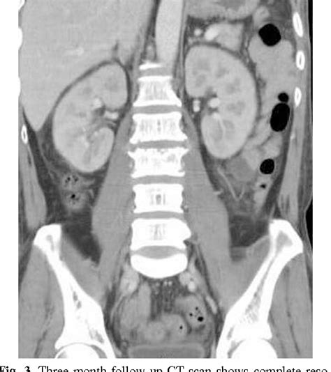 Figure 1 From Lumbar Pyogenic Spondylodiscitis And Bilateral Psoas