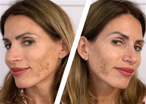 Clínica Especializada En El Tratamiento Del Melasma Dra Elena Arnal