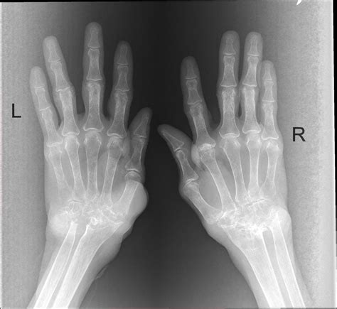 Pin On Bones Arthritis