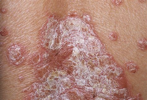 Plaque Psoriasis Pictures Causes Symptoms Treatment Home Remedies