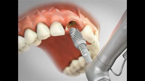 Zobni Implantati Dental Portal