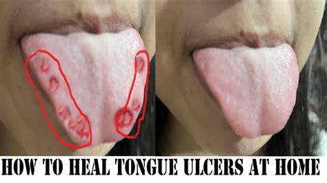 How To Heal Tongue Ulcers At Home Naturally Without Taking Any