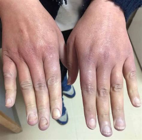 Cureus Raynauds Phenomenon Beware Of Cancers