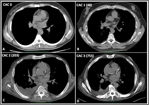 Coronary Artery Calcium On Standard Chest Computed Tomography Predicts