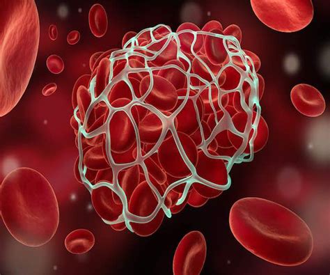 disseminated intravascular coagulation profile dr ziauddin hospital