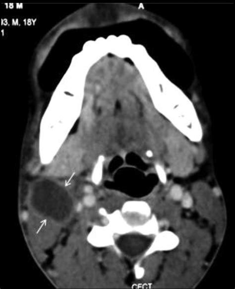 Second Branchial Cleft Cyst Contrast Enhanced Ct Scan Reveals A Cystic