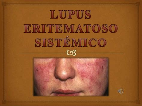 Lupus Eritematoso Sistemático Les