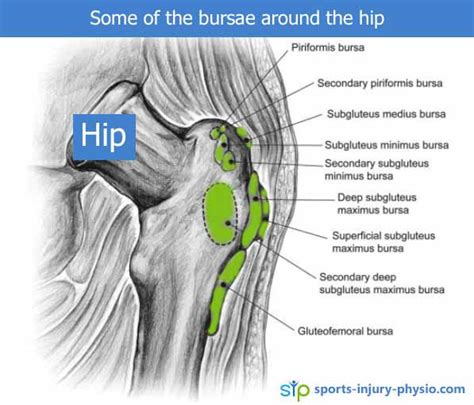 3 Interesting Facts About Hip Trochanteric Bursitis Sports Injury Physio