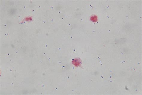 Medical Laboratory And Biomedical Science Csf Gram Stain Case