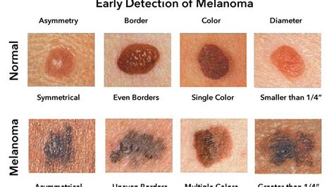 Melanoma Skin Cancer Treatment And Its Types Yashoda Hospital