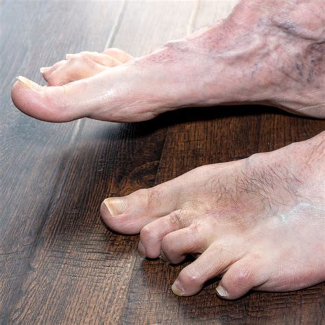 Bunions And Hammertoes The Hidden Link The Bunion Institute