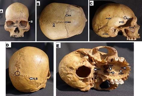 Suture et fontanelles bregma lambda lambda suture c5l mice skull bones back view suture lambda skull lambda suture nasofrontal suture to the. Composite photograph showing the facial and cranial ...