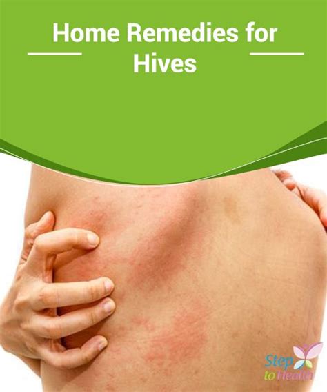How To Cure Hives Fast The Ultimate Guide Ihsanpedia