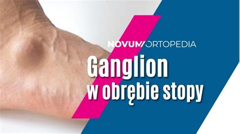 Ganglion Czym Jest I Jak Sobie Z Nim Poradzi Novum Ortopedia Youtube
