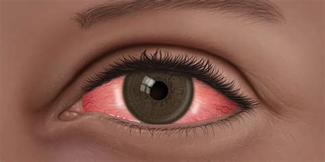 Conjunctivitis What Is Pink Eye American Academy Of Ophthalmology