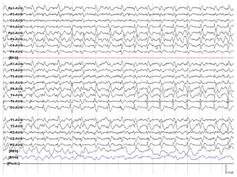 Example Of Periodic Lateralized Epileptiform Discharges See The