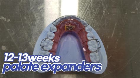 Orthodontic교정 Palate Expander 악궁확대장치 Youtube