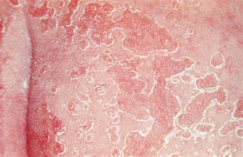 I have a redish area (almost like a rash) on my left thigh near my groin are. Yeast Infections