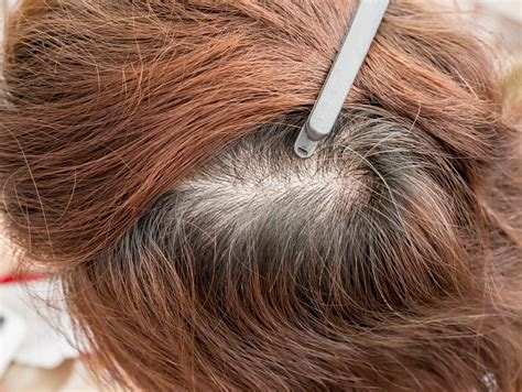 Ca Da De Cabello Enfermedades Que Pueden Causar La P Rdida De Pelo