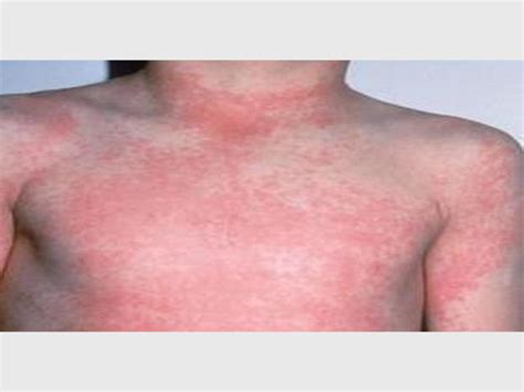 Scarlet Fever The Signs And Symptoms You Need To Know Review