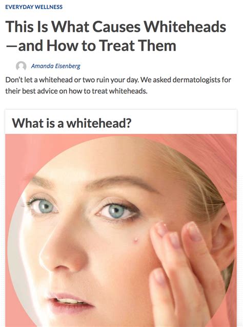 Ava Md Press This Is What Causes Whiteheads—and How To Treat Them Ava Md