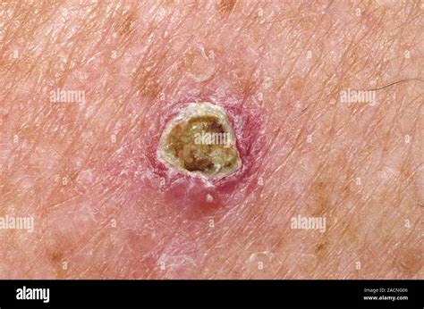 Close Up Of Basal Cell Skin Cancer On The Skin Of The Back In A 74 Year