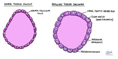Papillary Thyroid Carcinoma Mypathologyreportca