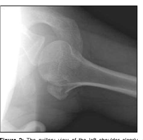 Figure 2 From Isolated Avulsion Fracture Lesser Tuberosity Of The