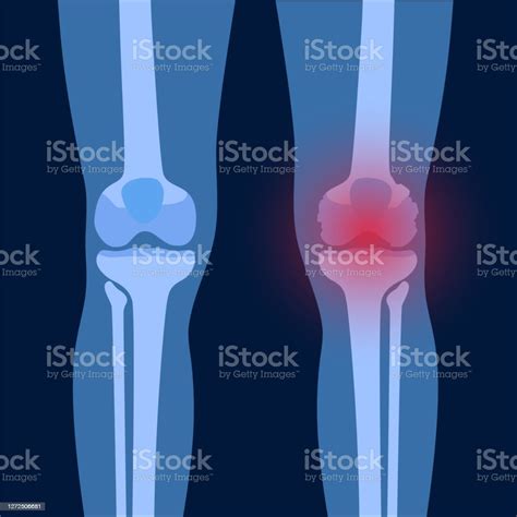 Arthritis In Knee Joint Stock Illustration Download Image Now