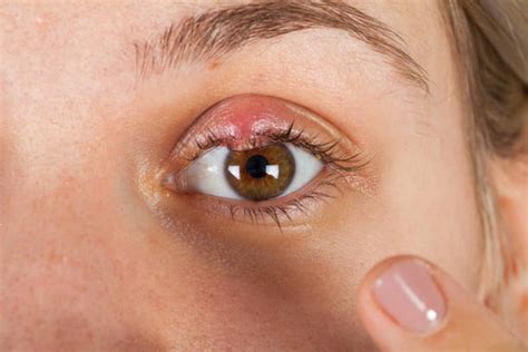 Swollen Eyelid Stock Photos Pictures And Royalty Free Images Istock