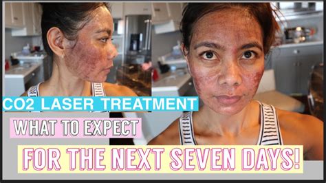 Co2 Laser Treatment What To Expect For The Next 7 Days Youtube