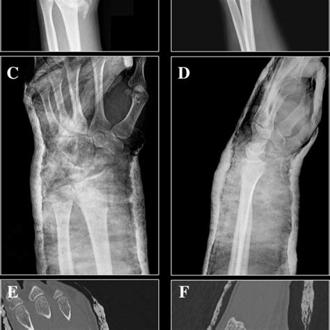 Case 2 A Ap Wrist Radiograph Show A Radially Displaced Distal Radius