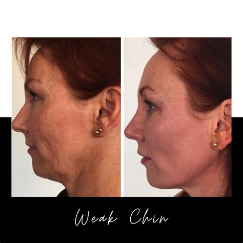 Weak Chin See Immediate Results Without Surgery