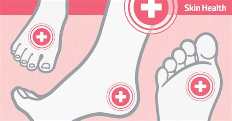 Diabetic Foot Ulcers Vs Venous Or Arterial Ulcers 3 Posters