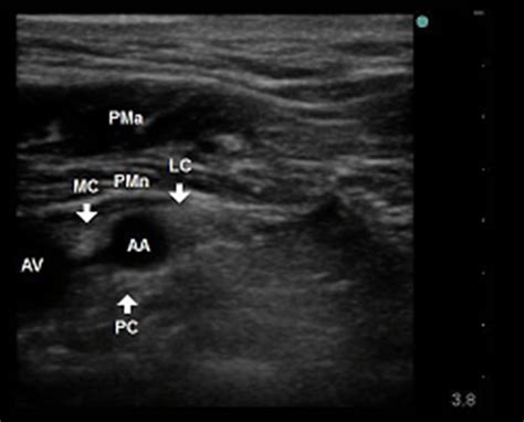 The Crucial Role Of Bilateral Infraclavicular Nerve Blocks In The