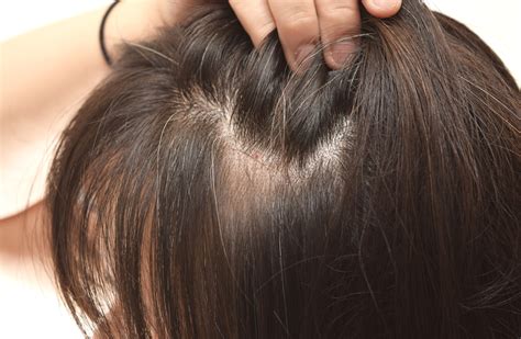 Female Pattern Baldness And Hair Loss On One Side Of Head