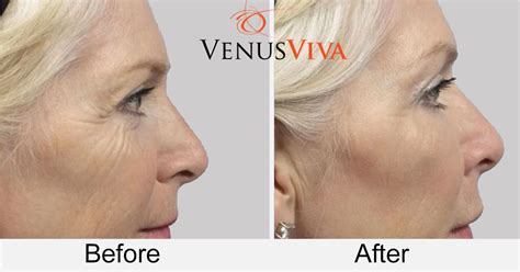 Non Surgical Neck Lift Rejuvenation Skin Tightening With Venus Viva