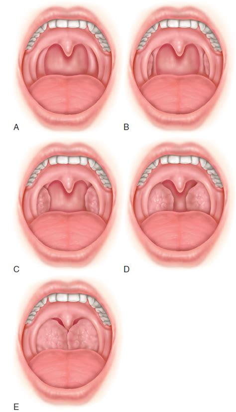 Basic Schema Of Tonsil Grading Important When Evaluating Grepmed
