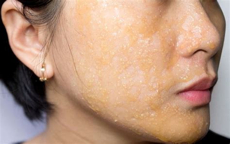 To know this, we need to understand what the excessive sebum do to your skin. Skin Acne (Pimples) Home Remedies| How to Get Rid of Acne ...