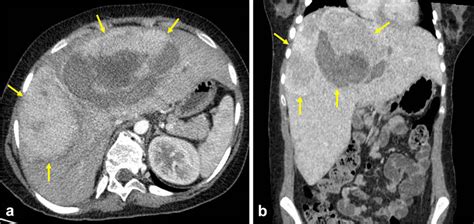 Contrast Enhanced Abdominal Ct Arterial Phase A And Portal Venous