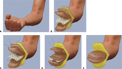 Management Of Upper Limb Amputations Journal Of Hand Surgery