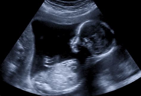 13 Weeks Pregnant Ultrasound Scan Accuracy Procedure And More