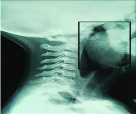 Soft Tissue Lateral Neck X Ray Suggestive Of An Homogenous Mass Arising