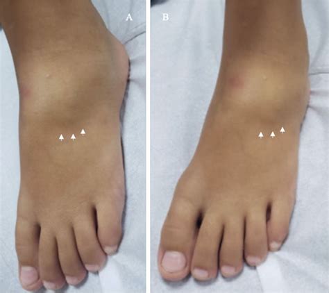 Cuboid Nutcracker Fracture In A 9 Year Old Child Bmj Case Reports