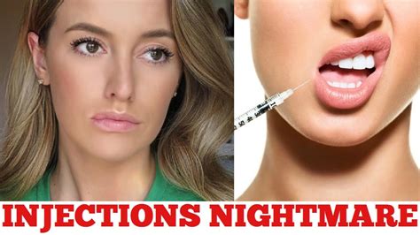 Lip Injections Nightmare Lip Injections Gone Wrong Youtube