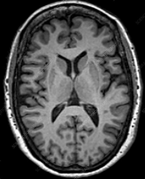 Normal Brain Mri Stock Image C0393546 Science Photo Library