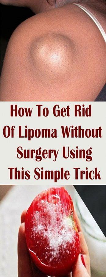 How To Get Rid Of Lipoma Without Surgery Using This Simple Trick Lipoma